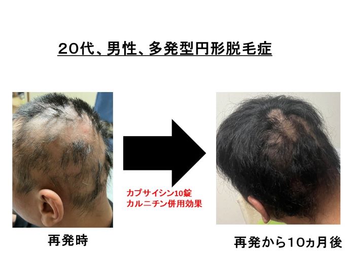 円形脱毛症　病院